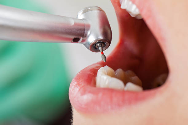 Best Emergency Treatment for Dental Infections or Abscesses in West Pelzer, SC